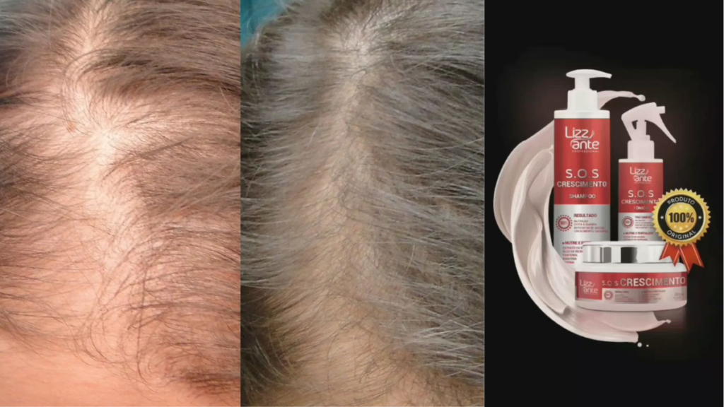 Antes e depois - Alopecia tratada com Kit S.O.S Crescimento em 120 dias